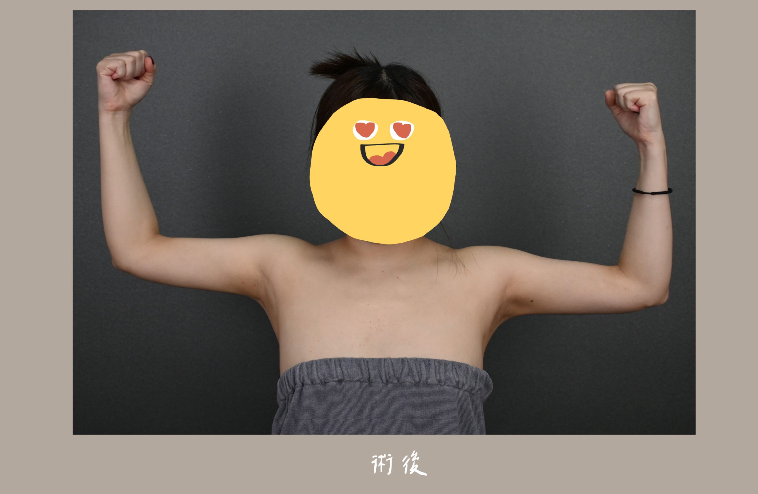胡守丞院長-威塑2.2抽脂手臂+腹部環抽術後三個月