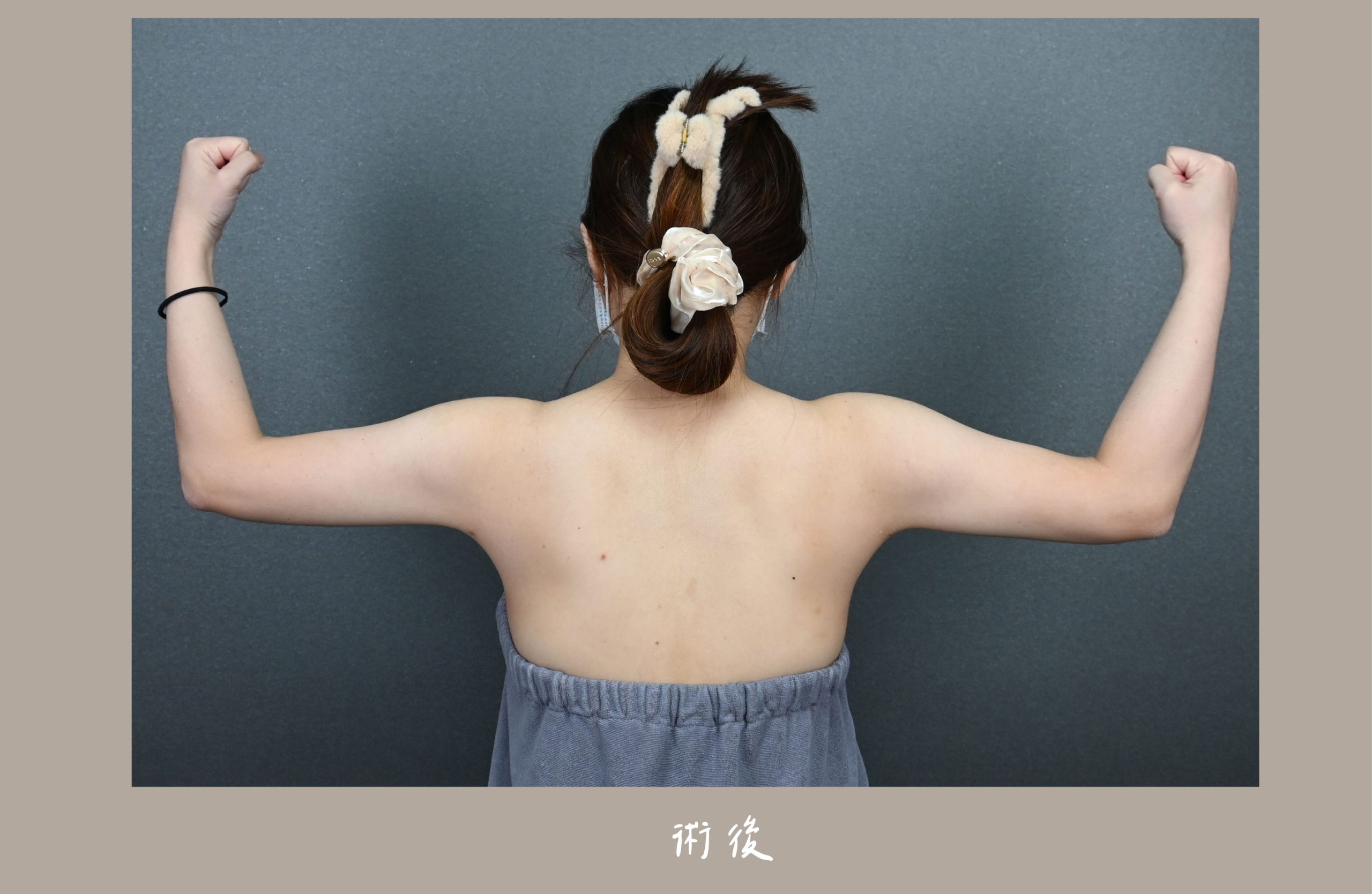 胡守丞院長-威塑2.2抽脂手臂+腹部環抽術後三個月