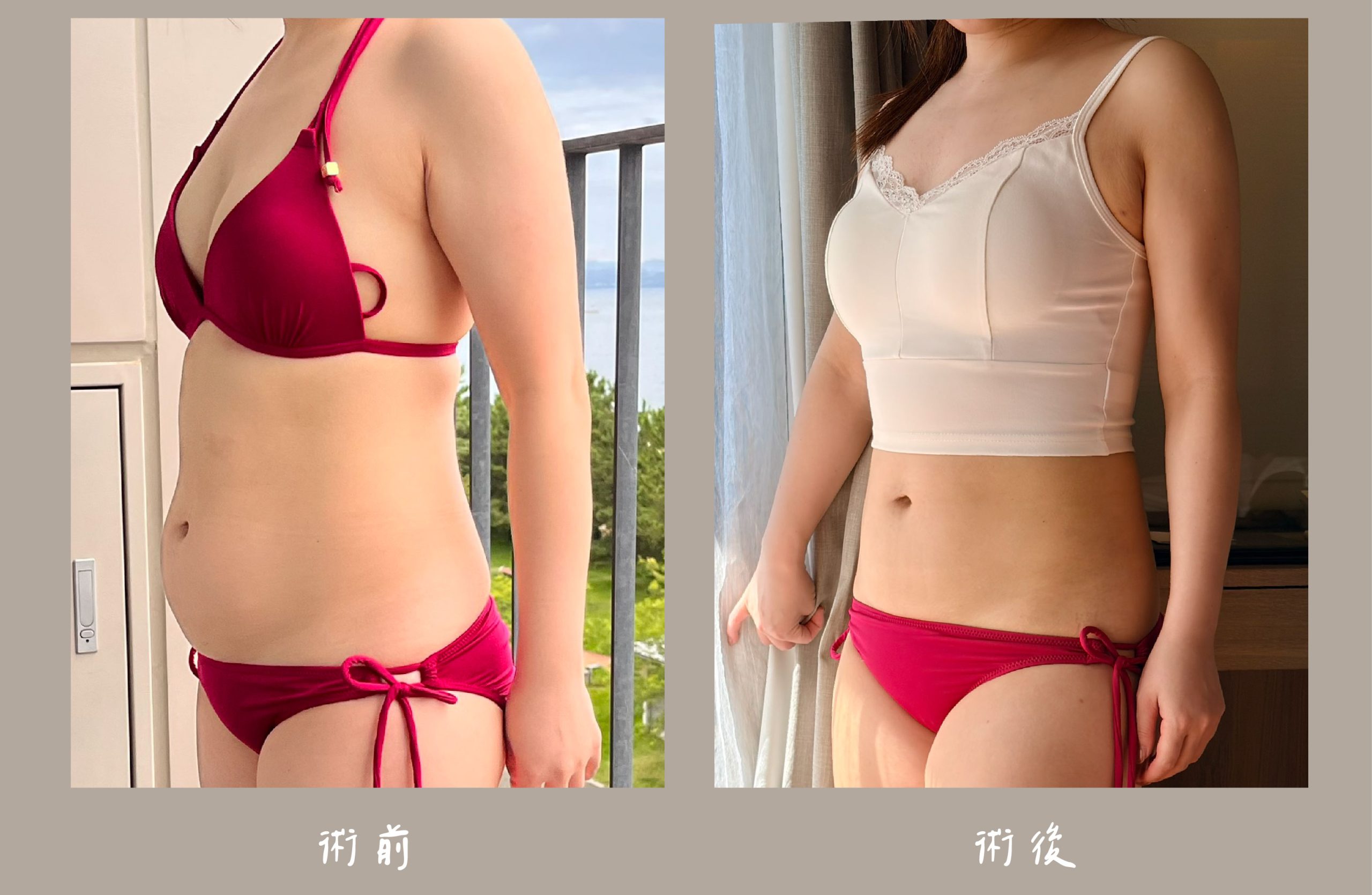 胡守丞院長-威塑2.2抽脂術前術後對比-手臂+腹部環抽案例-新顏診所