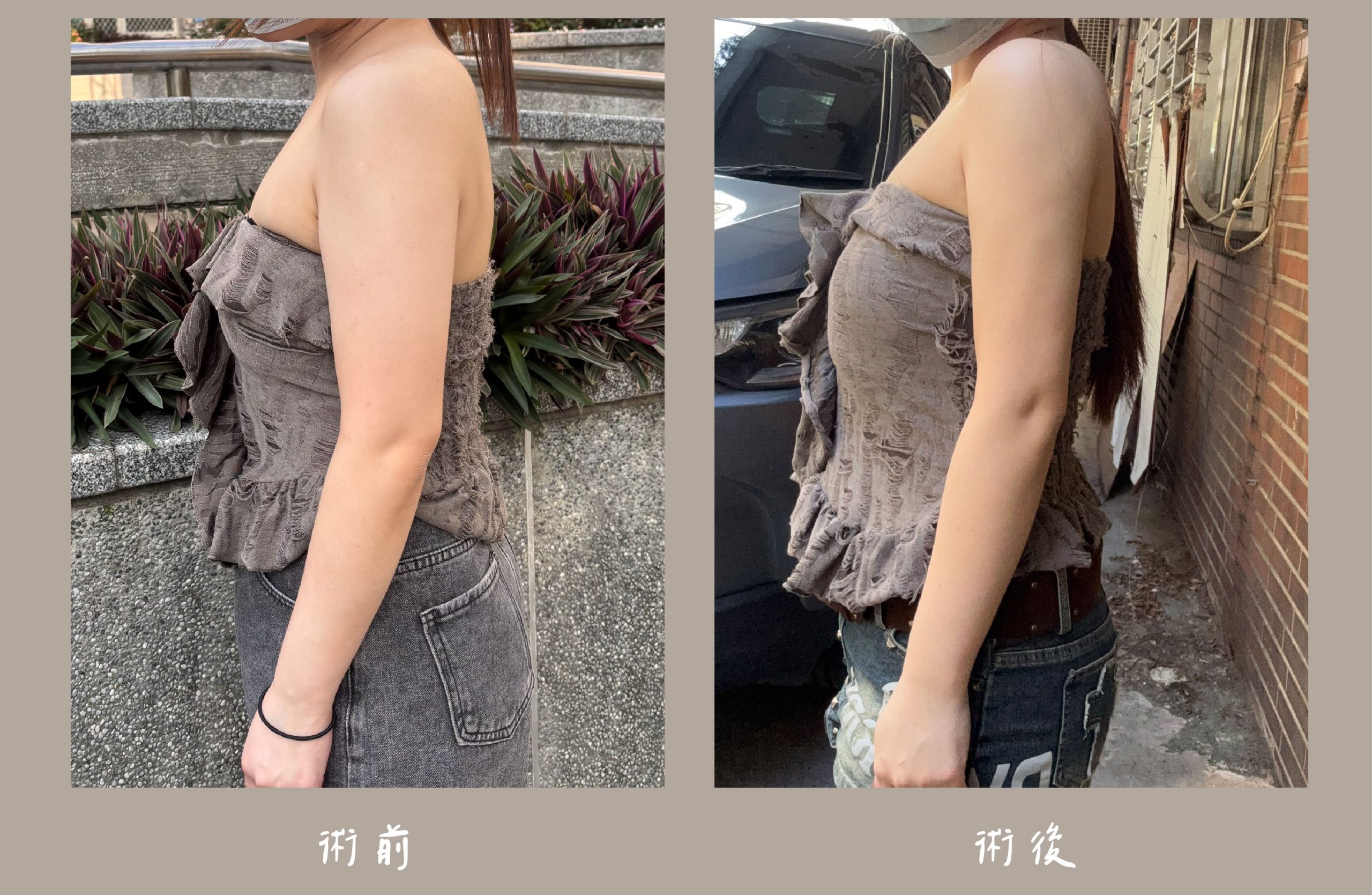 胡守丞院長-威塑2.2抽脂術前術後對比-手臂+腹部環抽案例-新顏診所