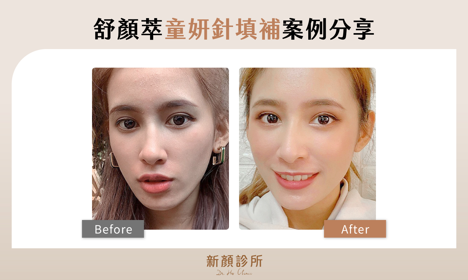 舒顏萃童顏針填補案例分享。