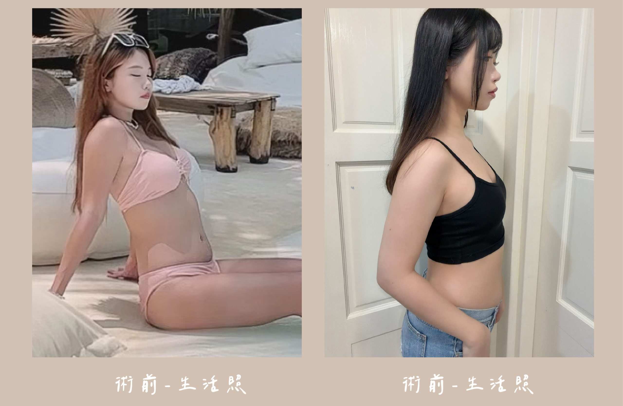 胡守丞院長-威塑2.2抽脂術前生活照