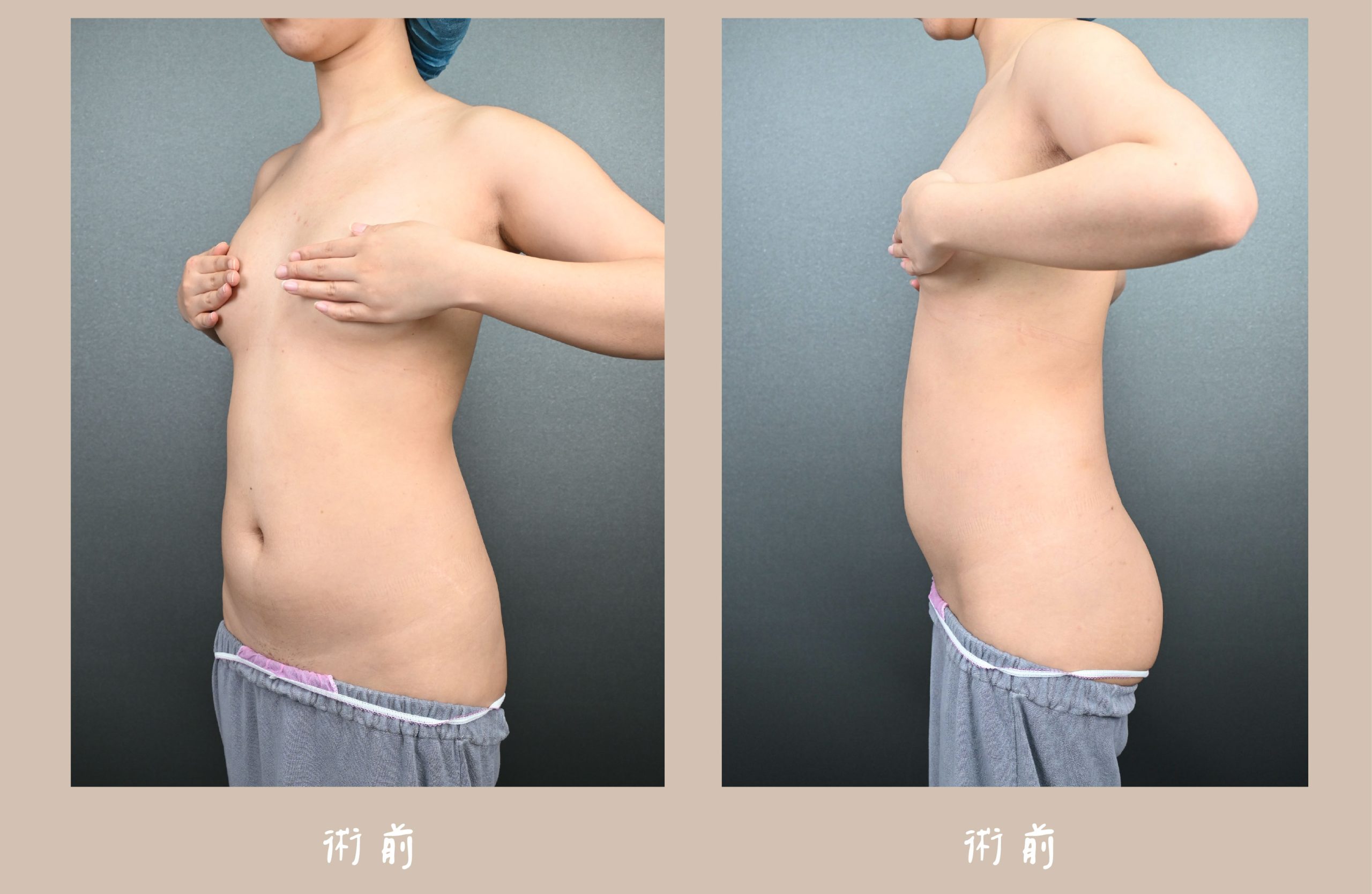 胡守丞院長-威塑2.2抽脂自體脂肪補胸&腹部環抽術前