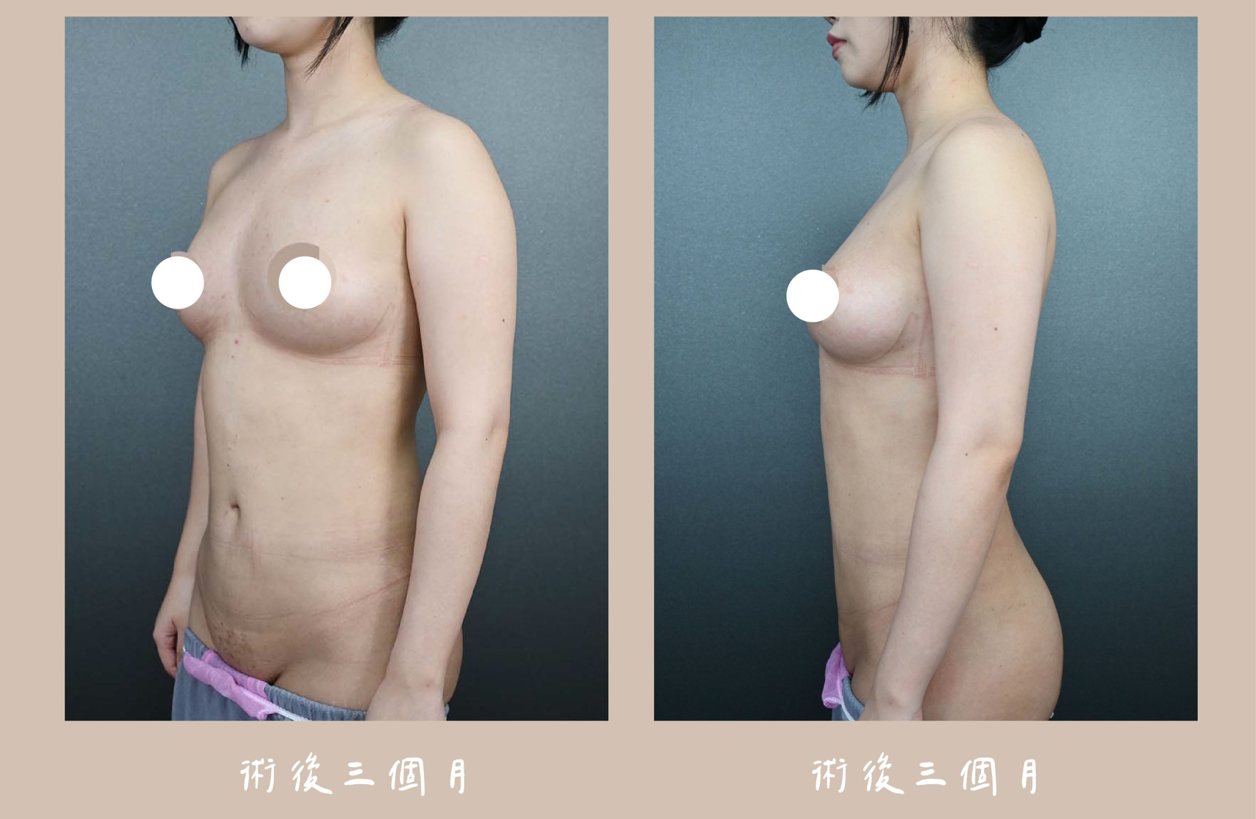 胡守丞院長-威塑2.2抽脂自體脂肪補胸&腹部環抽術後第三個月