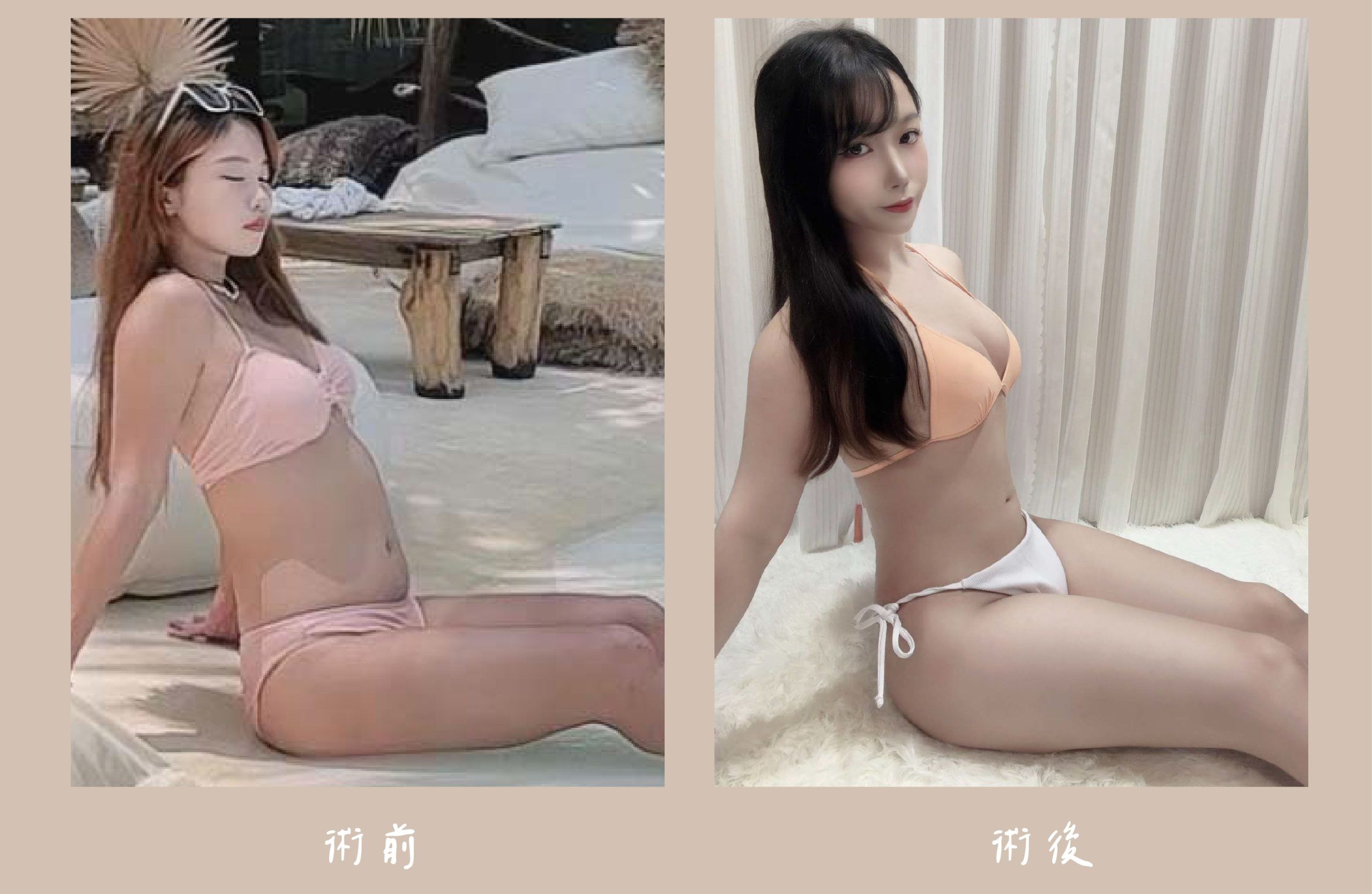 胡守丞院長-威塑2.2抽脂術前術後對比-自體脂肪補胸+腹部環抽案例-新顏診所