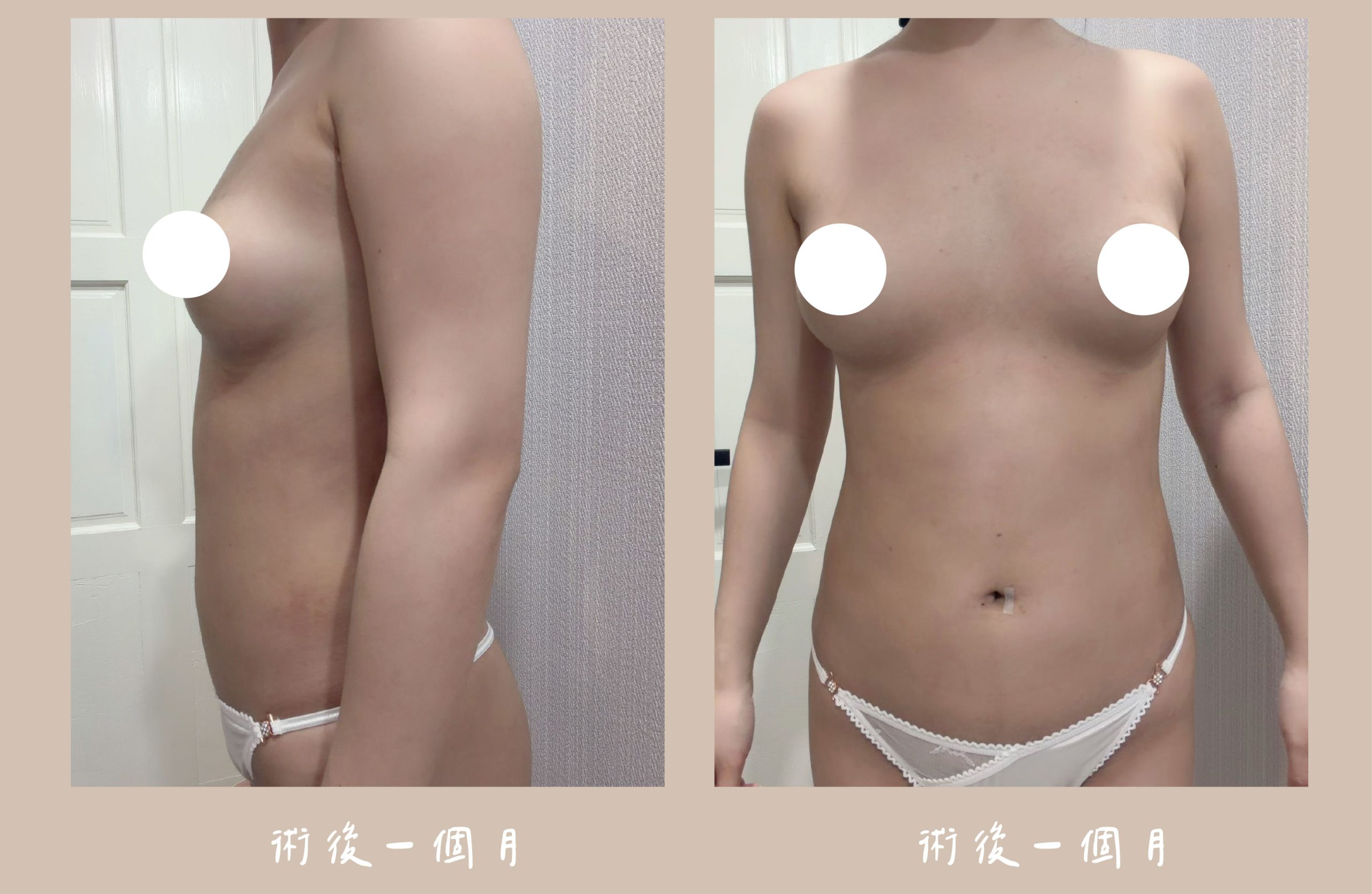 胡守丞院長-威塑2.2抽脂自體脂肪補胸&腹部環抽術後第一個月