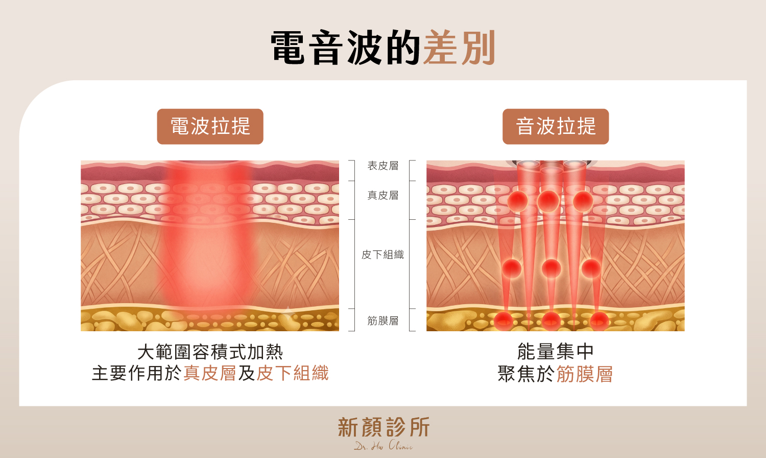 電波拉提主要作用於真皮層及皮下組織,音波拉提能量集中聚焦筋膜層