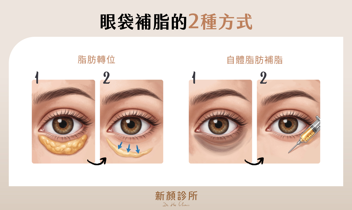 眼袋補脂的2種方式:脂肪轉位與自體脂肪補脂