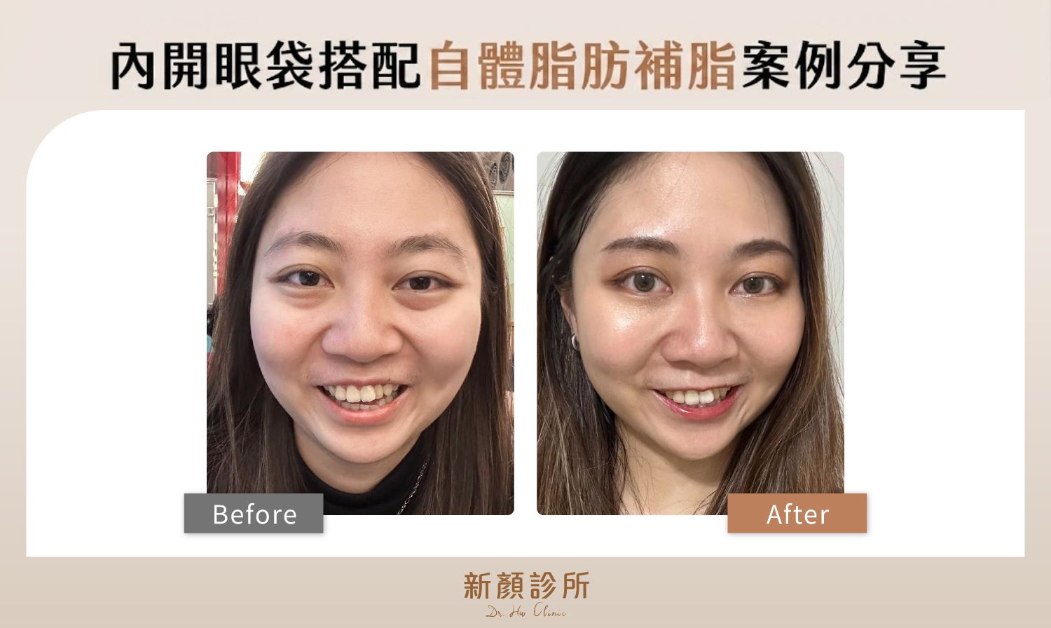 內開眼袋搭配自體脂肪補脂案例分享