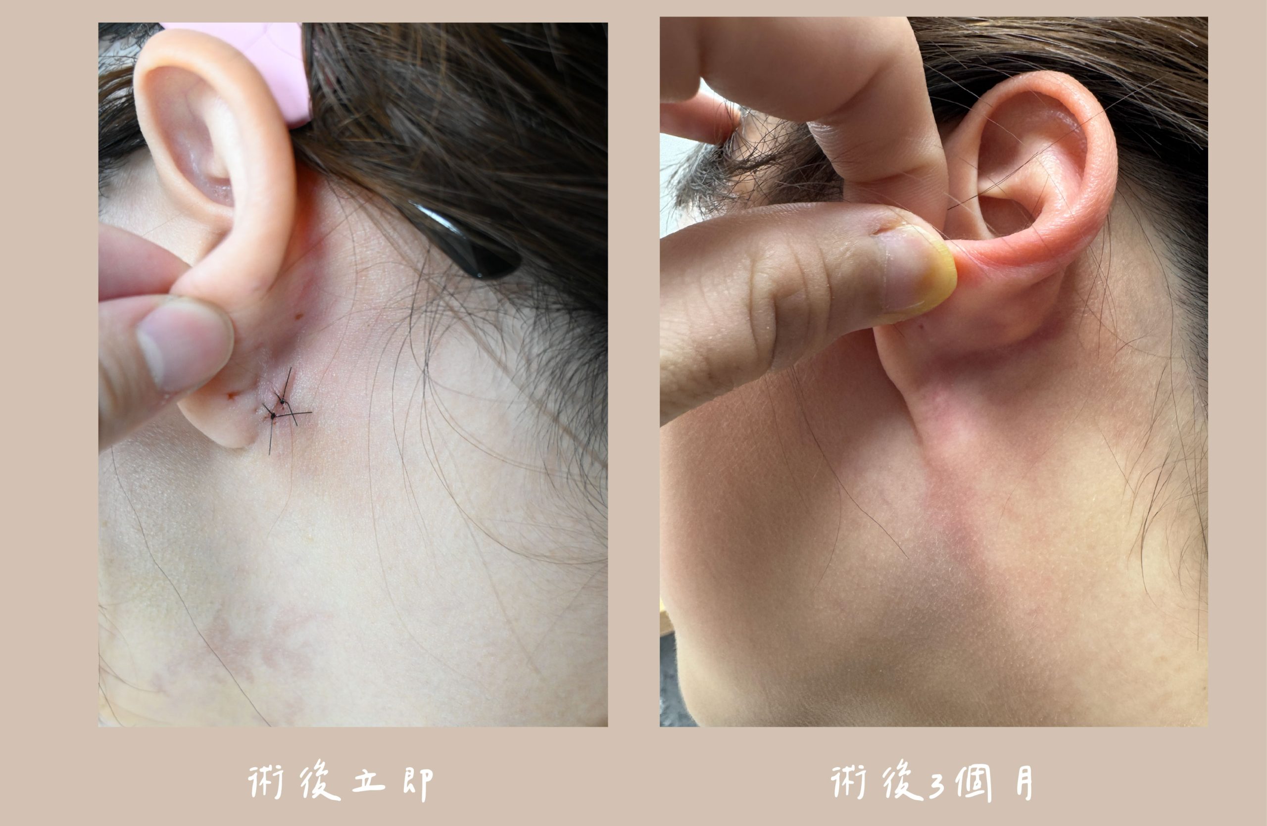 胡守丞醫師-威塑2.2抽脂術後-雙下巴