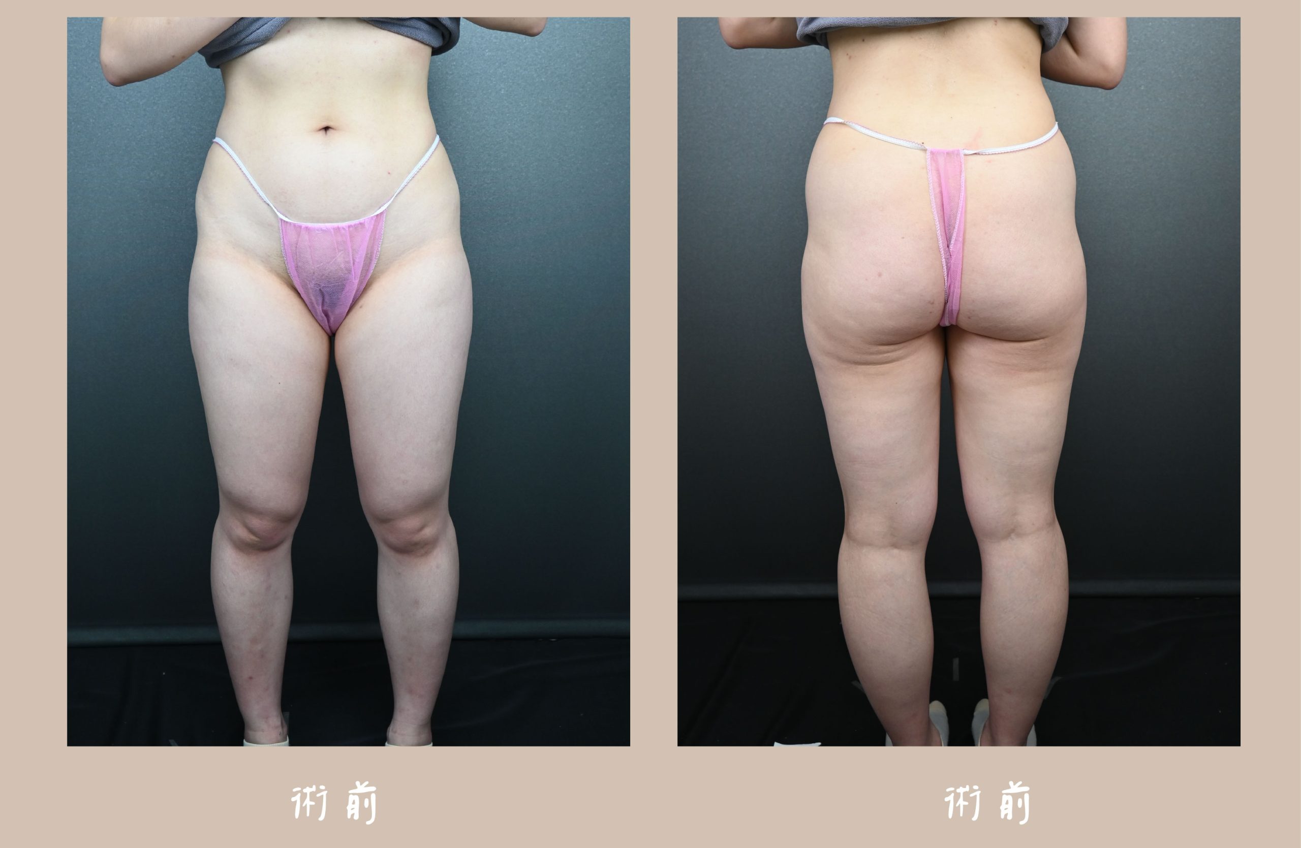 胡守丞院長-威塑2.2抽脂大腿環抽術前