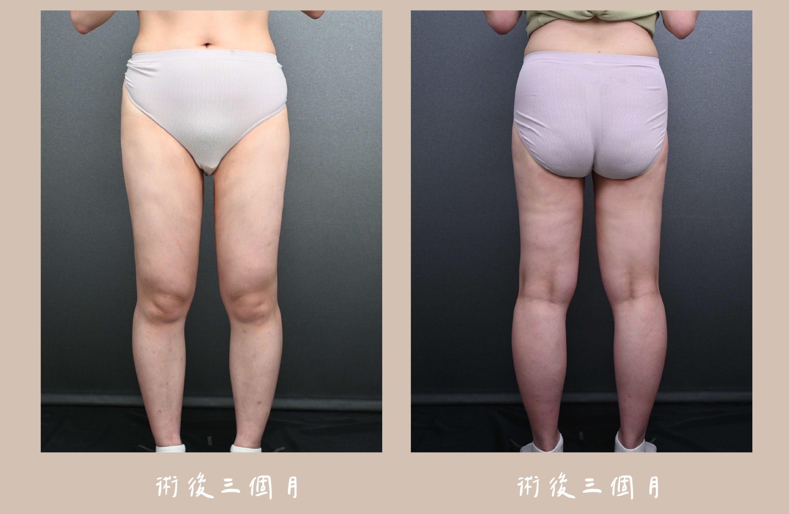 胡守丞院長-威塑2.2抽脂 大腿環抽術後3個月