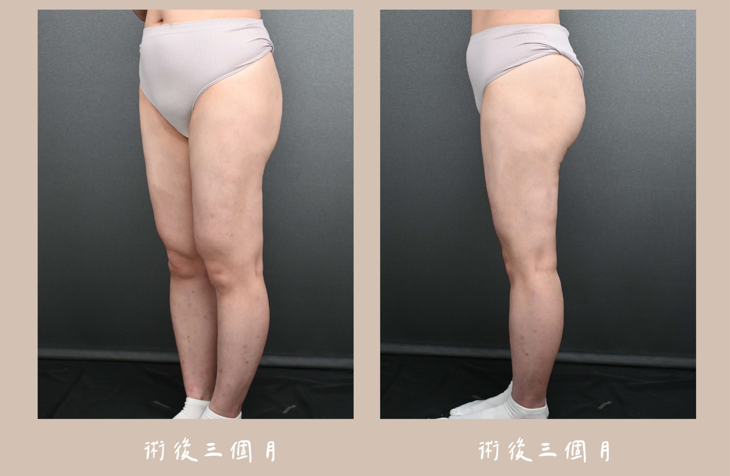 胡守丞院長-威塑2.2抽脂 大腿環抽術後3個月