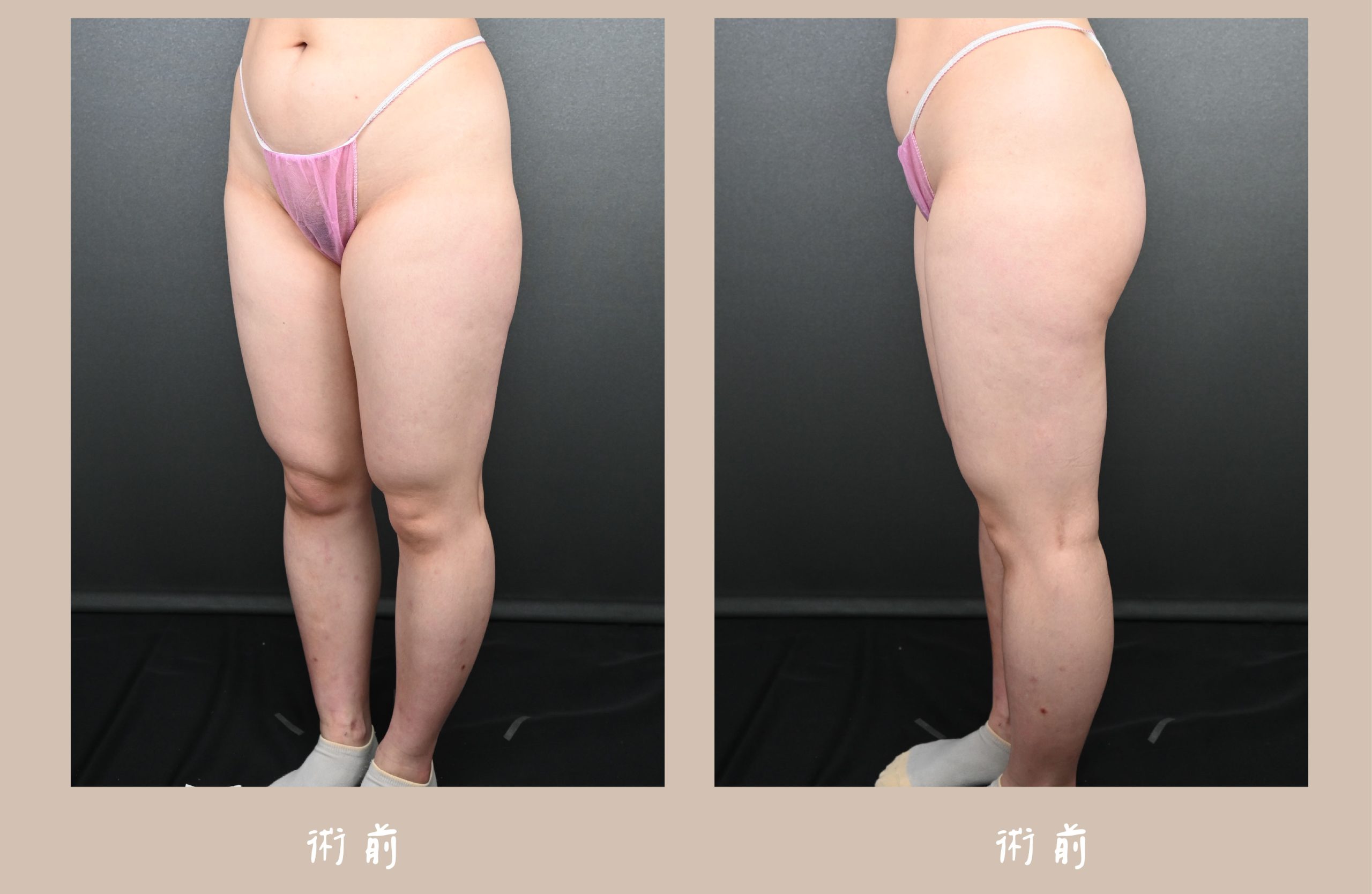 胡守丞院長-威塑2.2抽脂大腿環抽術前