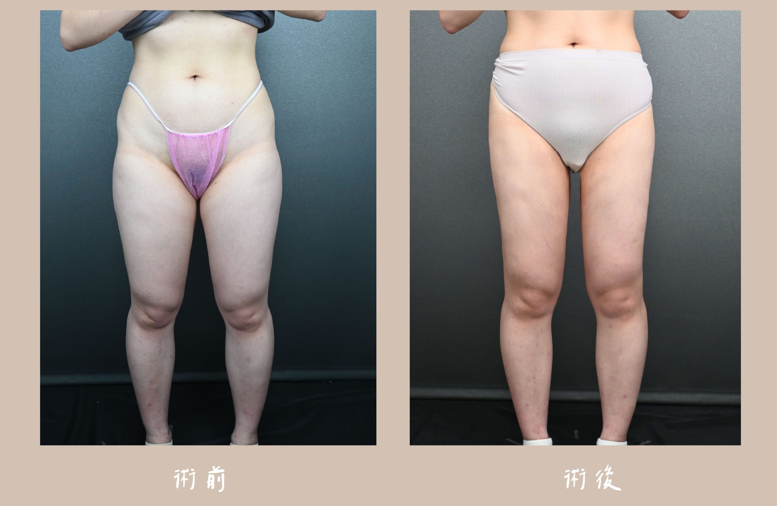 胡守丞院長-威塑2.2抽脂術前術後對比-大腿環抽-新顏診所