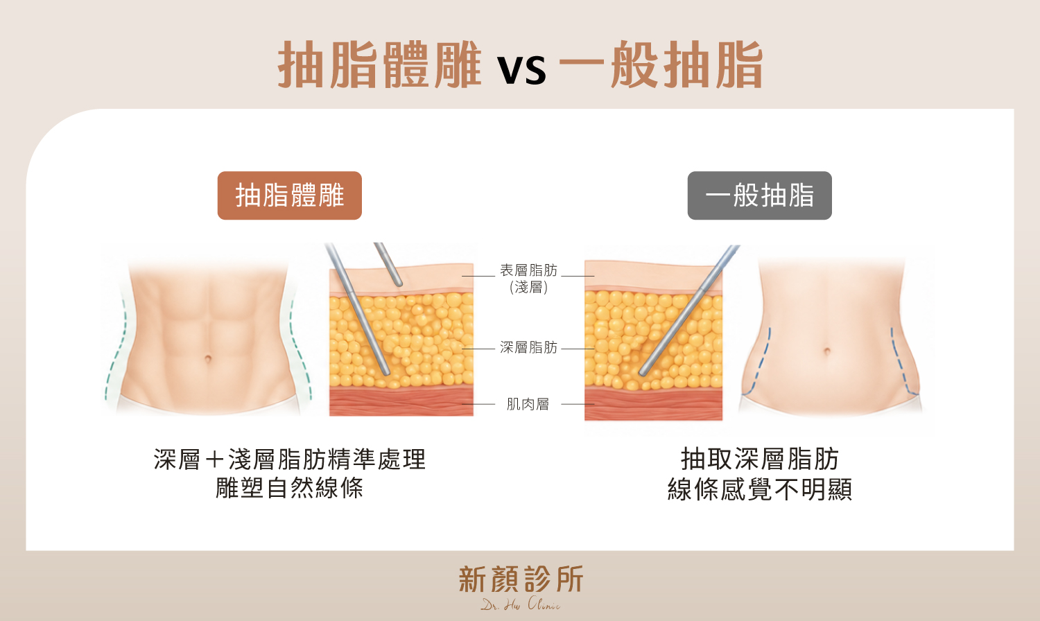 抽脂體雕可以針對深層與淺層脂肪精準處理,雕塑自然線條