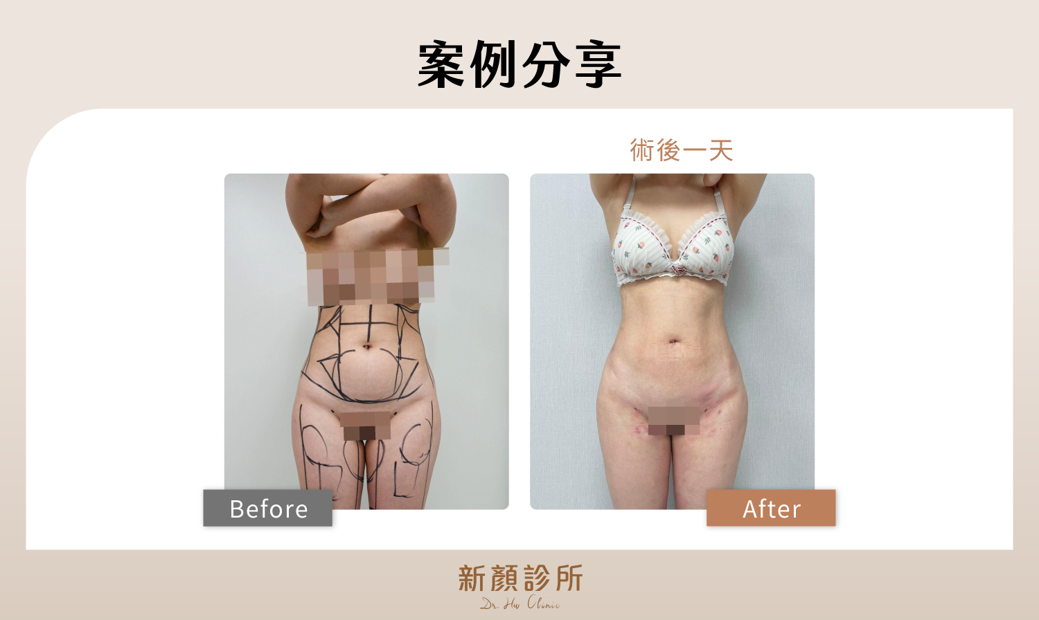 患者接受微創威塑抽脂處理腹部曲線,手術後隔天馬甲線就已經浮現。