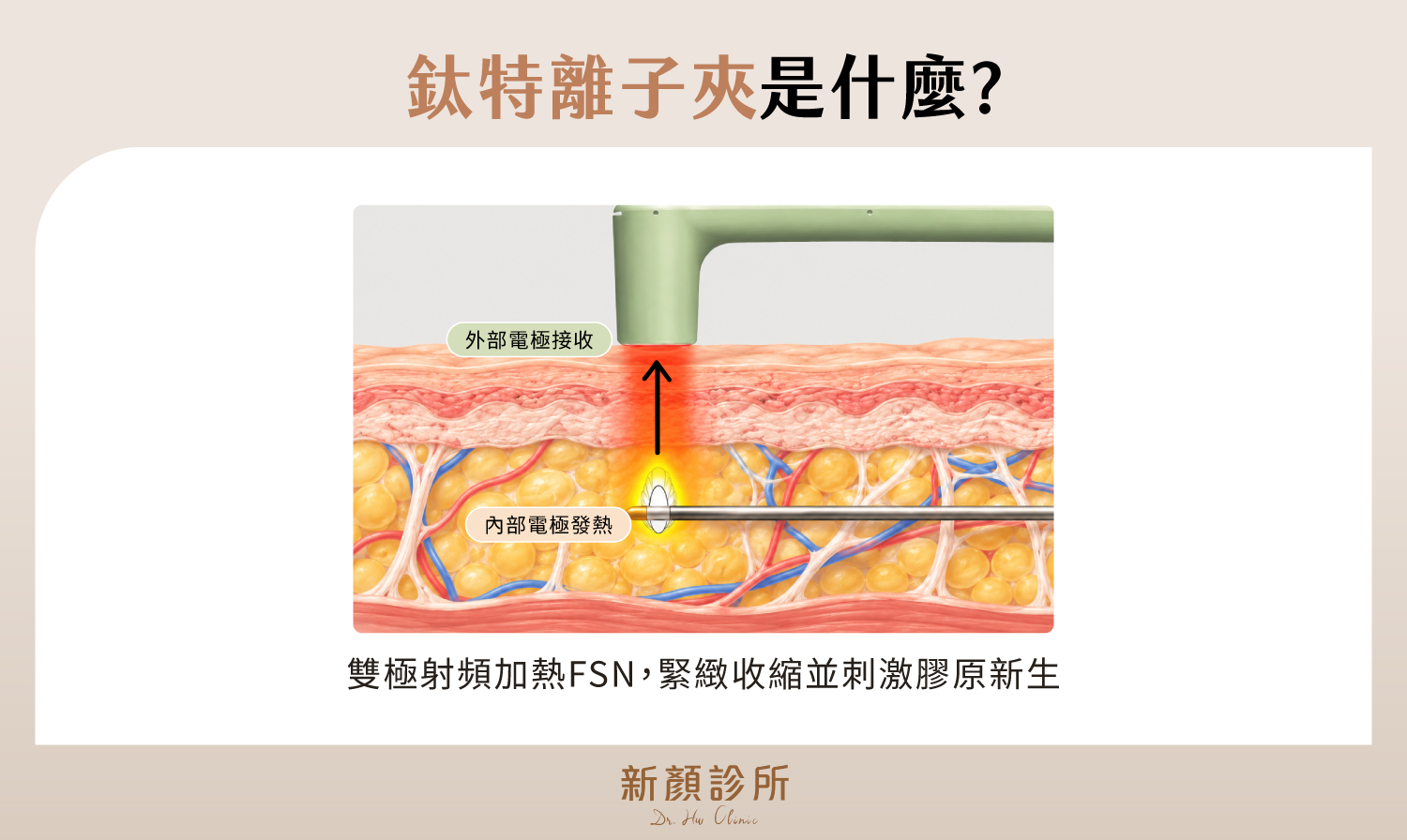 鈦特離子夾透過雙極射頻加熱纖維中隔網(FSN),刺激膠原蛋白新生